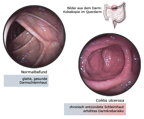 Colitis Ulcerosa