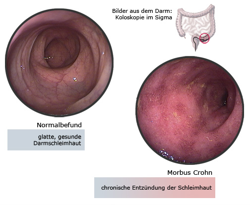 Morbus Crohn