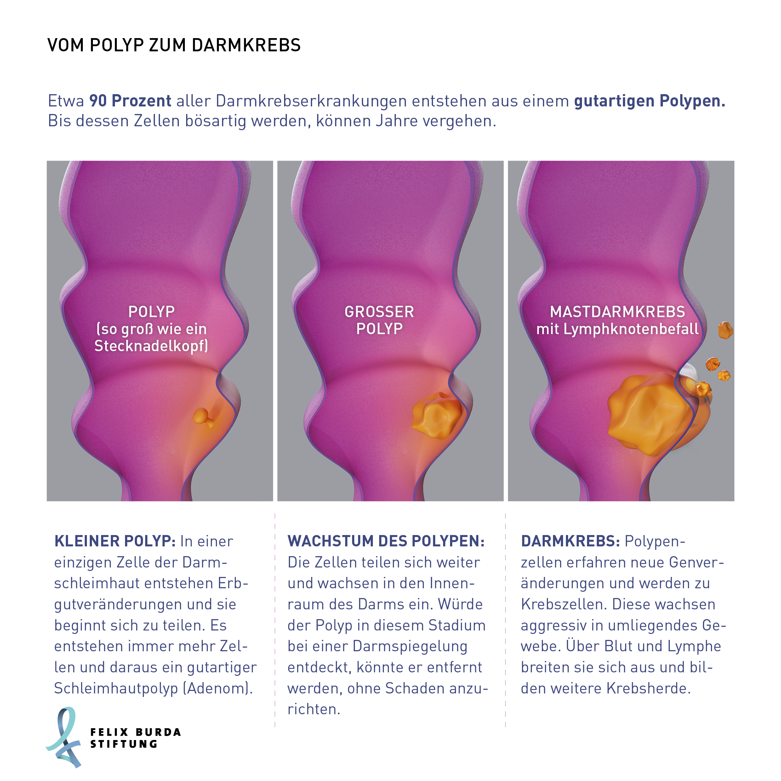 vom Polyp zum Darmkrebs