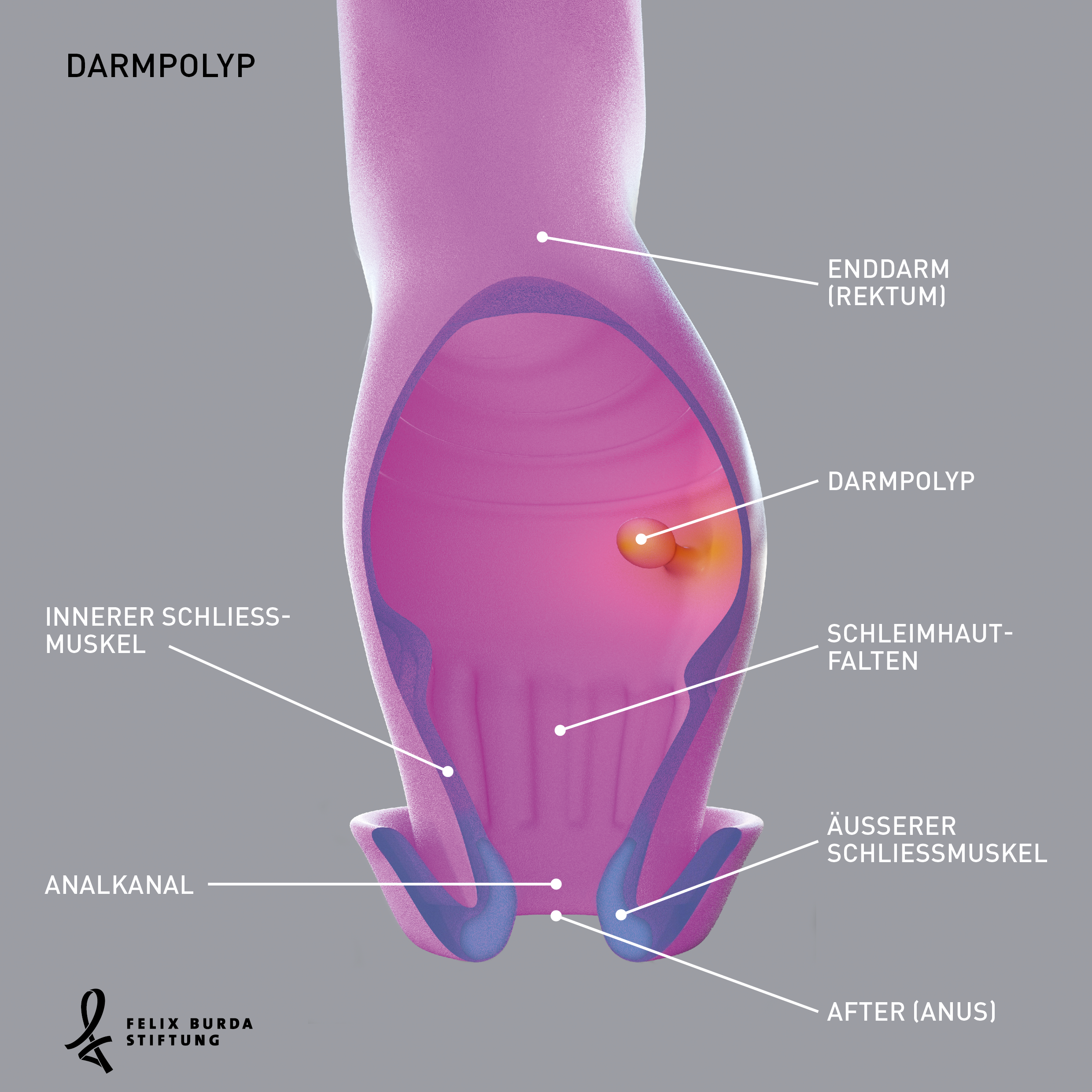 Darmpolyp